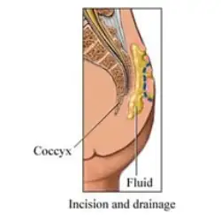 Incision-et-drainage