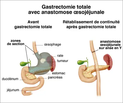 P2-gastrectomie-totale-et-anastomose