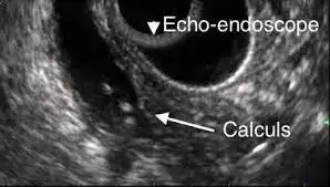 lithiase-vesiculaire-echoendoscopie