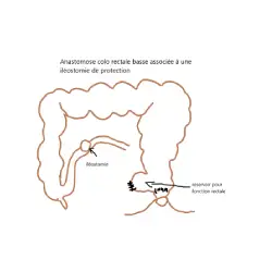 anastomose colorectale et ileostomie