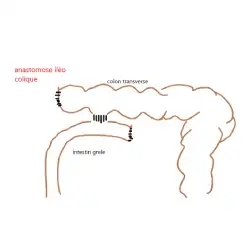 anastomose ileo loique
