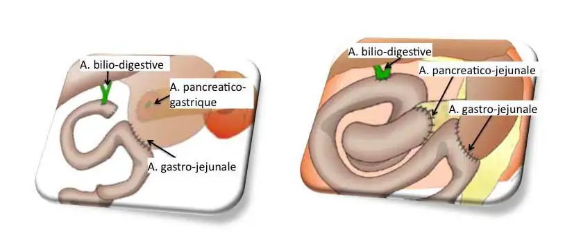 chirurgie-du-pancreas