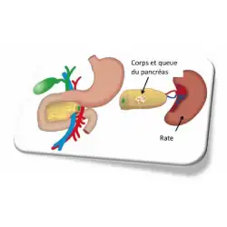 chirurgie-du-pancreas