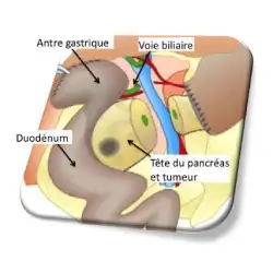 chirurgie-du-pancreas