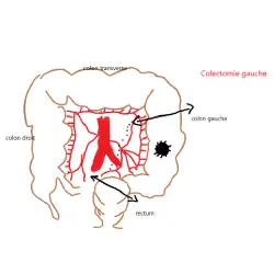 Colectomie gauche