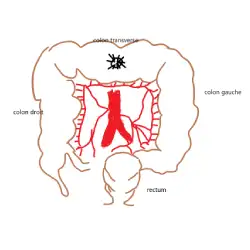 Colectomie transverse