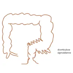 diverticulose-sigmoidienne