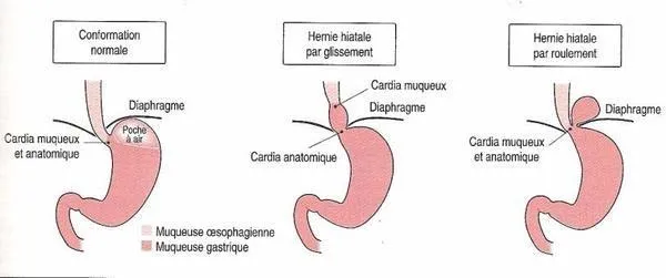 hernie-hiatale-1