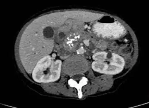 pancreatite-chronique-1