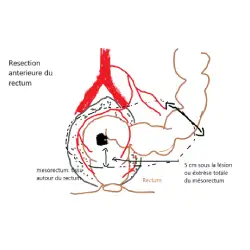 resection anterieure rectum