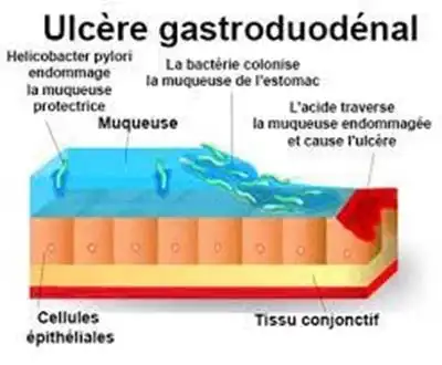 ulcere-gasrtoduomedal